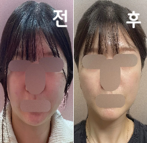 후기가 많아서 믿고 시술 받았습니다! 갸름해진 게 느껴졌어요!