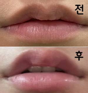 가격 같아서 좋았고 입술필러 맞으니 기분이 좋아용~