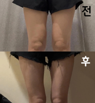 허벅지 포키주사 맞은 지 일주일이 지났습니다. 효과는 부종이 빠진 정도이지만 조금이라도 가늘어질 수 있어서 기뻤습니다!