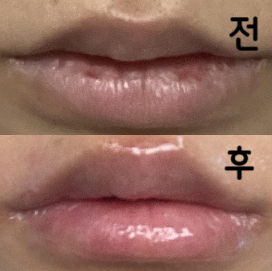 원장님 친절하시고 꼼꼼하게요~ 직원분들도 불필요한 권유 안 하세요~ 단점은 대기가 길다!