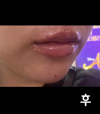 짧은턱, 얇은 입술이 고민이라 필러 맞았고 만족합니다!