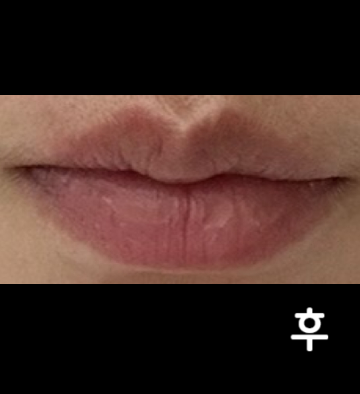 입술라인 위에 필러가 있어서 녹였어요~ 윗입술만요~