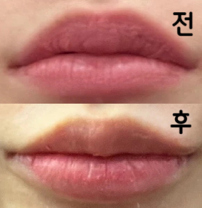 듀 입술 말고 자연스러운 느낌 원했는데 너무 맘에 들어요~ 의사쌤이 니즈파악 잘 해주시고 꼼꼼하게 잘 놔주세욤.. ㅎ