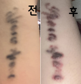 문신제거 알아보다가 가격도 저렴하고 잘 해주셔서 꾸준히 이용중이에요!