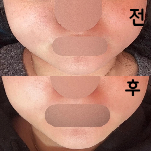 얼굴 지방이 많아서 넙대대 해 보여서 고민이었는데 여기서 처음 맞고 살 빠졌냐는 소리 들었어요~!