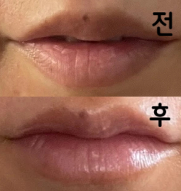 일본에서 받은 입술필러보다 효과가 높고, 가격도 저렴하고, 통증도 적었습니다!