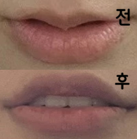 얇은 입술이 예전부터 고민이어서 맞게 되었습니다. 원장님께서 꼼꼼히 봐주시면서 맞춰주신 덕분에 원하는 입술로 재탄생하게 되었어요! 이목구비가 또렷해진 느낌입니다~