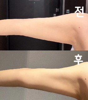 상담도 정중했고 주입 중에는 다소의 통증이 있었지만 선생님도 간호사도 상냥했고 통역사가 상담, 시술 중에도 옆에 있어주었기 때문에 안심하고 시술 받을 수 있었습니다!