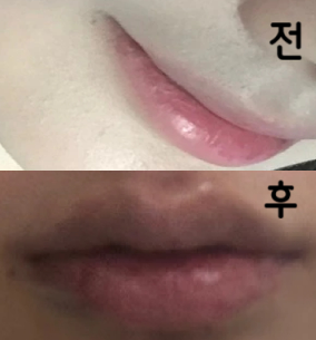 첫 입술필러라 망할 수도 있을 것 같아서 저렴한 걸로 했는데 필러 빠지면 무조건 여기서 다시 맞을 겁니다!! 친구들도 다 어디서 했녜요!!