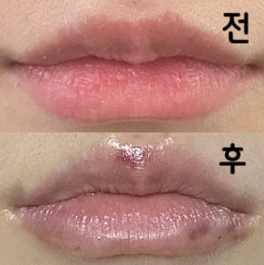 시술 꼼꼼하게 해주셔서 주기적으로 받으러 오려구요!