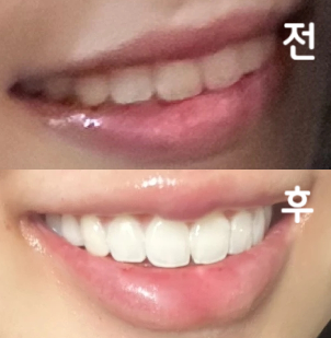 원장님이 진짜 하나하나 다 잡아주시고 질문에 대답해주시면서 저에게 맞춤화된 시술을 해주셔서 너무 좋았어요!