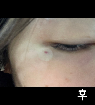 한 쪽은 괜찮은데 다음날 정도 되니 한 쪽은 멍이 꽤 들었어요 ㅎ 효과 기대해봅니당~