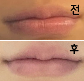 대기시간은 많이 길었지만 거울보여주시면서 만져주며 시술했습니다!