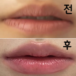 리터치 받고 난 후! 진짜 맘에 들어요 원장님 매우 친절하시구.. 제 고민도 척척 이해해주셔서 짱이었습니다 ㅜ