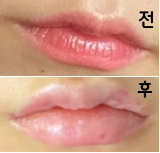 원장님도 친절하고 꼼꼼하게 필러 놔주시고 중간에 어떤지 확인까지 해주셔서 더욱 믿음이 갔습니다!