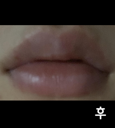 입술이 안으로 말려서 너무 얇아보여 고민이었는데 상담할 때 예시 사진도 보여주시고 편하게 해주셔서 시술 잘 받았습니다!