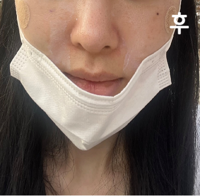 기대 이상으로 만족해서 또 받고 싶은 시술이에요! 앞으로는 롤리팝으로 정착해서 다닐 듯 해요 대만족입니다!!