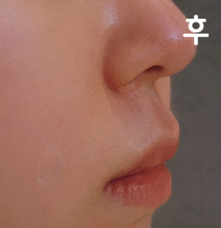 마취해서 하나도 안 아프고 친절하고 꼼꼼하게 해 주셨어요 ㅎㅎ 팔자주름 있는 편이라 몇 번 더 시술 받으려구요!! 감사합니다~