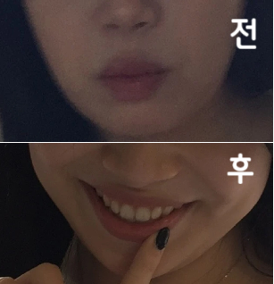 웃고 있어서 티는 잘 안나는게 진자 효과 다음날부터 직빵으로 와요!!