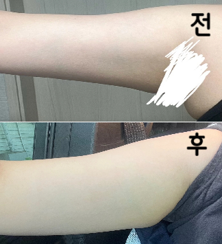 부유방은 확실히 정리 되었고 팔과 얼굴은 약간 정리된 느낌이 듭니다. 3회차까지 더 맞아보려구요!!