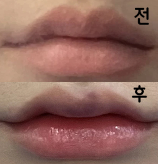 올라간 입꼬리가 굉장히 맘에 들어요!! 입술필러는 처음이라 걱정했지만 결과가 맘에 들어요!!!!!!!!!