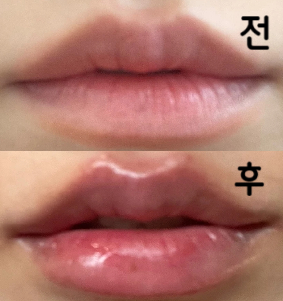 결과적으로 비대칭 없이 만족스러운 입술이 됐습니다~