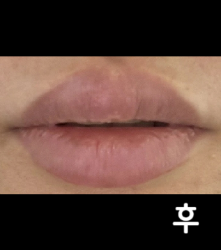 상담도 편하고 특히 선생님 시술이 너무 맘에 들어요!!