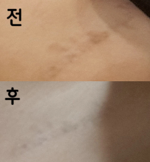 대기가 길지만 의사선생님들이 모두 친절하시고 꼼꼼합니다! 이제 두 세 번 정도만 받으면 다 없어질 것 같아요!