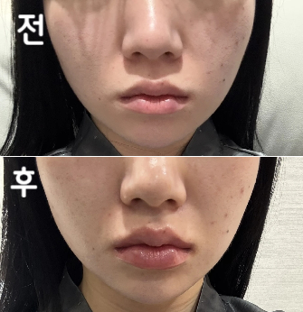 살이 찌면 얼굴부터 쪄서 라인정리 겸 받아봤는데 저는 만족스러웠어요~ 조만간 또 받으러 가려구요:)