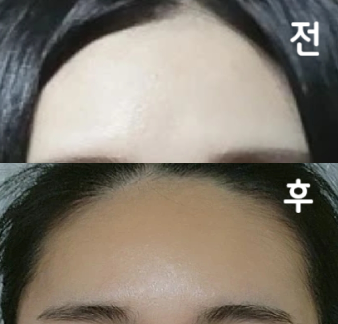 꼼꼼히 시술 해 주셔서 효과가 좋았어요~