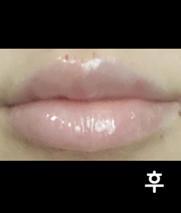 입술필러 받았는데 정말 만족스러웠어요^^