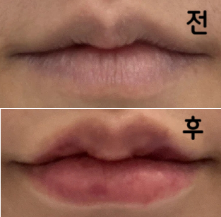처음 해 본 입술필러 긴장한 것 치곤 너무 안 아프게 잘 해주셨어요~