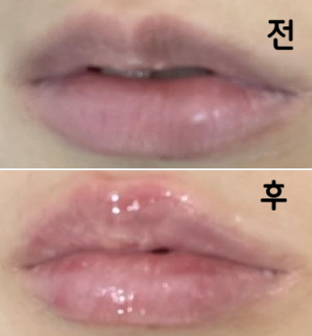 롤리팝 입술 필러 두 번째 맞았어요! 너무너무 맘에 들어요~ 추천합니다!!