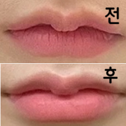 의사분이 젤 꼼꼼하게 봐주시면서 시술해주셨어요 ㅎㅎ