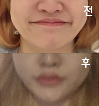 꾸준히 맞아서 그런지 살은 쪄도 얼굴 살이 빠져서 그런지 주변에서 살 찐 줄 몰라욤 ㅎㅎ 저렴하게 얼굴라인 정리할 수 있는 가성비 시술 bb