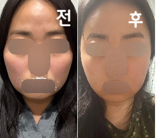 멍이 들어서 아쉽지만 효과는 대단해요! 라인정리는 최고입니다 증말루~