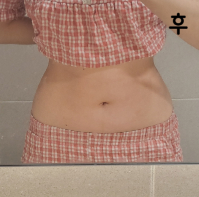 다이어트를 해도 아랫배는 안 빠지길래 결혼 전에 한 번 받아봤는데 상담도 친절하게 잘 해주시고 담당쌤도 친절하게 설명해주셔서 마음에 들었어요!!