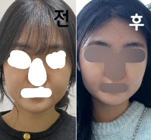 의사선생님이 시술 전에 얼굴 보시고 얼굴 지방 양에 맞게 알아서 배치해주심. 하루 지나니까 붓기 빠지고 주일이나 2주 후에 효과 나온다고 했는데 벌써 라인 정리된 느낌!!