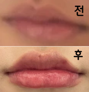 의사쌤께서 꼼꼼하게 시술해주시고 모양도 잘 잡아주셨어요!