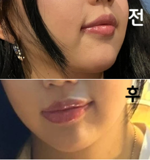 저는 효과를 진짜 잘 봐서 3회차까지 받았어용 최고에용~!