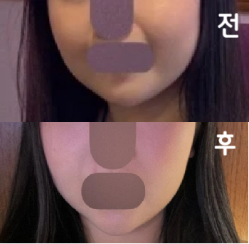 한 2주 정도 확 갸름해지구 다시 돌아오는 느낌이지만 가격대비 좋아요~!
