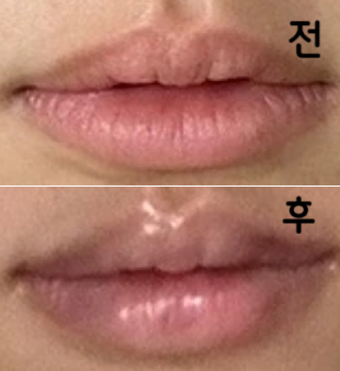 처음에 부어서 조금 걱정이였는데 붓기가 빠지고 보니 너무 예뻐서 너무 만족스럽고 다시 올 것 같아요~!