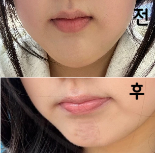 주사 맞고 살 빠졌다는 말 많이 들었고 통증도 거의 없었어요!!