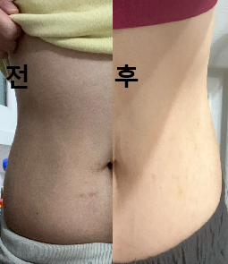 통증에 약한 분들께 특히 추천드려요!!