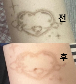 여러 군데 다녔는데 여기가 제일 잘 지워져요!