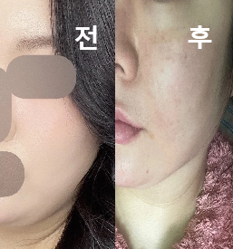 두 번째인데 효과가 좋아요!