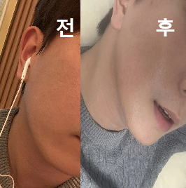 계속 주기적으로 맞을 생각입니다!