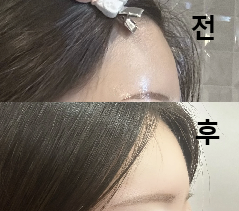 들쭉날쭉하고 꺼져있던 이마가 둥글고 자연스럽게 이뻐졌어요!