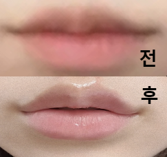 멍도 안 들고 하나도 안 아팠어요!