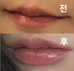 모양이 너무 예쁘고 바로 일상생활 할 수 있었어요!